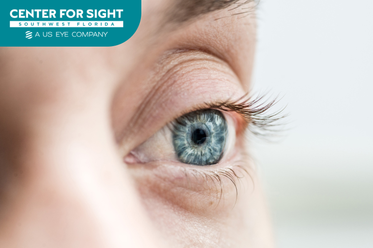 cataract surgery by cfsswfl